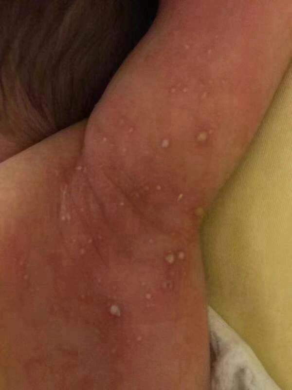 婴儿脓疱疹也称为脓疱疮,主要是因为皮肤的感染而引起的,婴儿皮肤