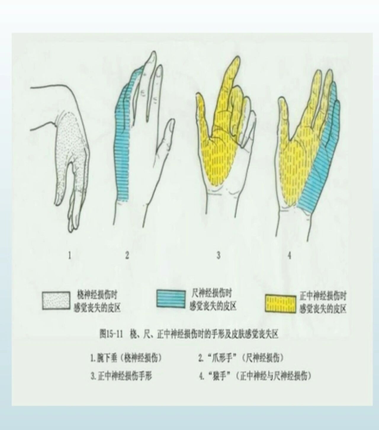 手部神经支配口诀图片