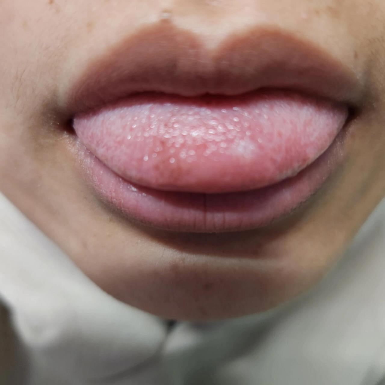 请问这是舌尖溃疡吗 好几天了 一开始还没有这么明显 就是碰到痛 今天