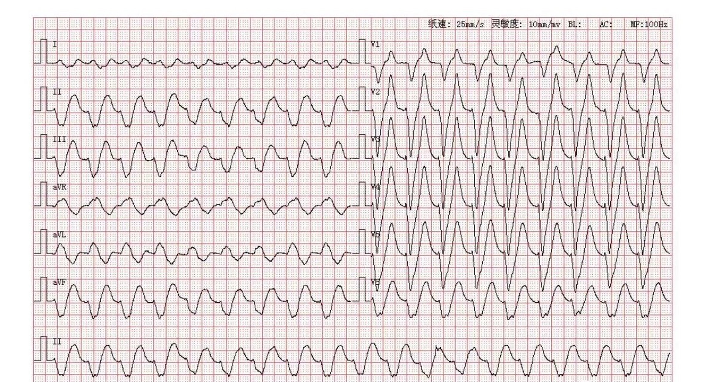 酷似室速的心电图图片