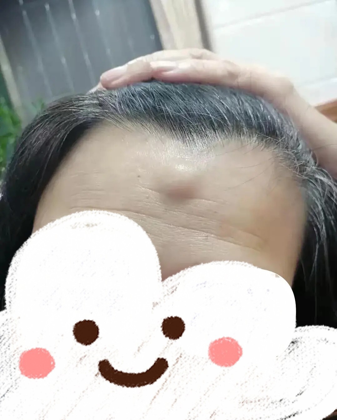 额头长包图片额头脂肪瘤手术图片额头上长了个良性肿瘤图片手术后的
