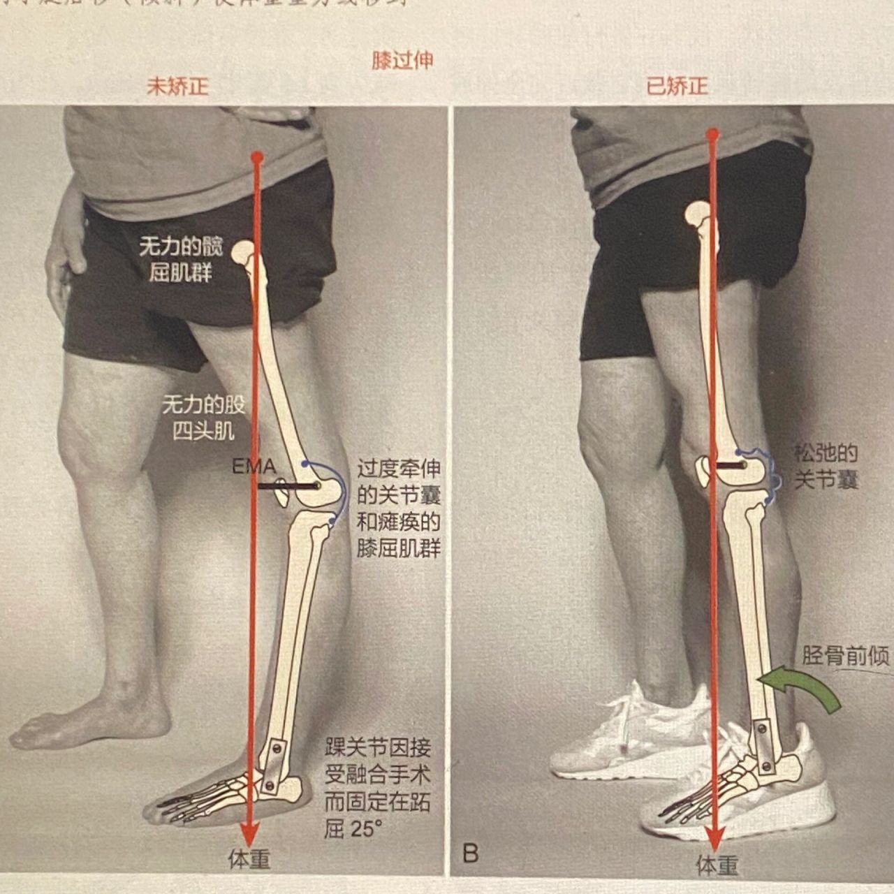 膝超伸与骨盆前移的关系及恢复训练 今天要分享的内容是:膝超伸的成因