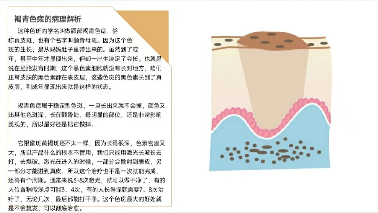 褐青色痣的专业解析73 96褐青色痣的病理解析这种色斑的学名叫做