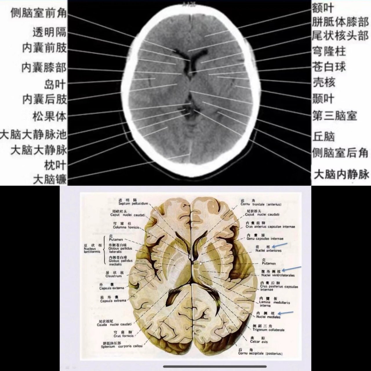 基底节钙化图片