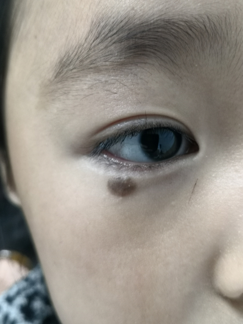 眼睑下方的色素痣症状