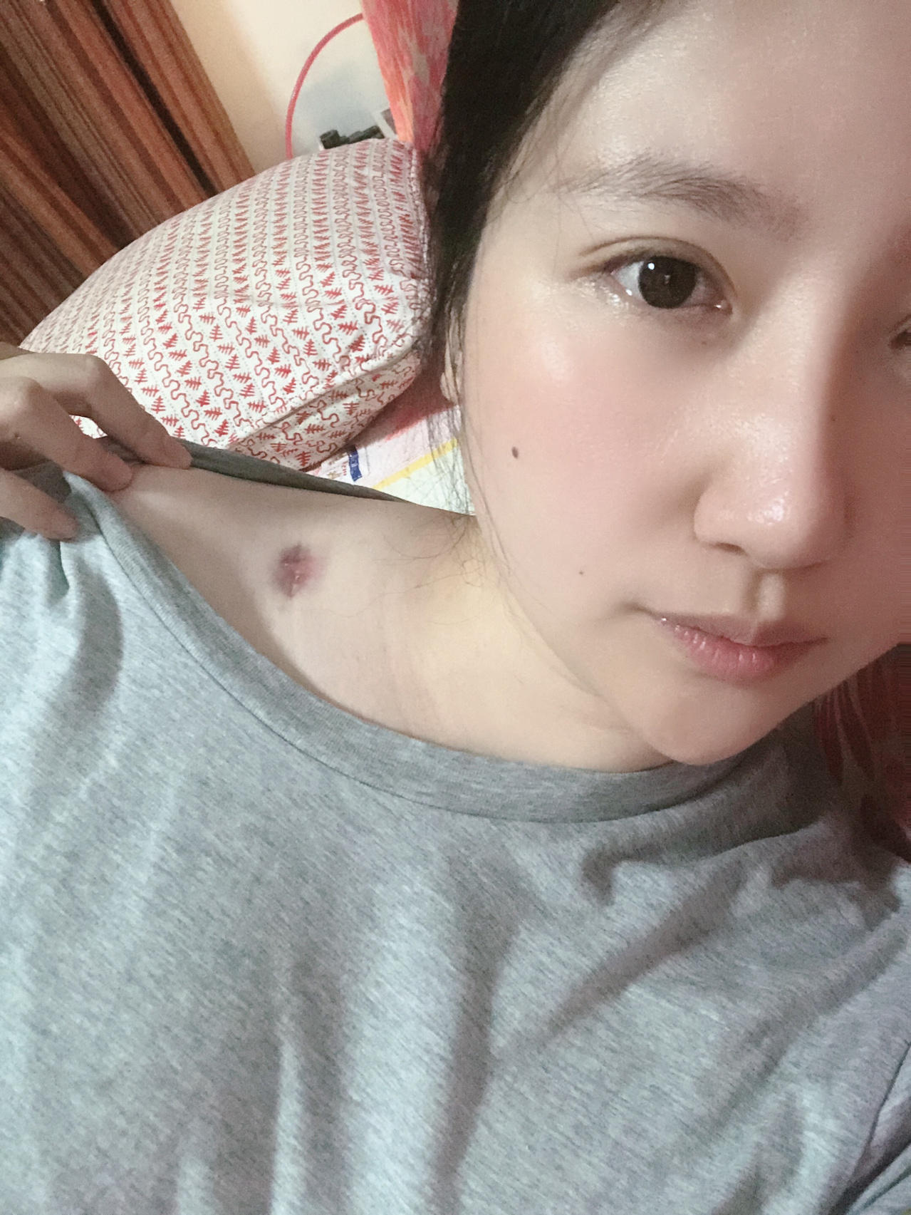 罕见的隆突性纤维瘤被我遇上了