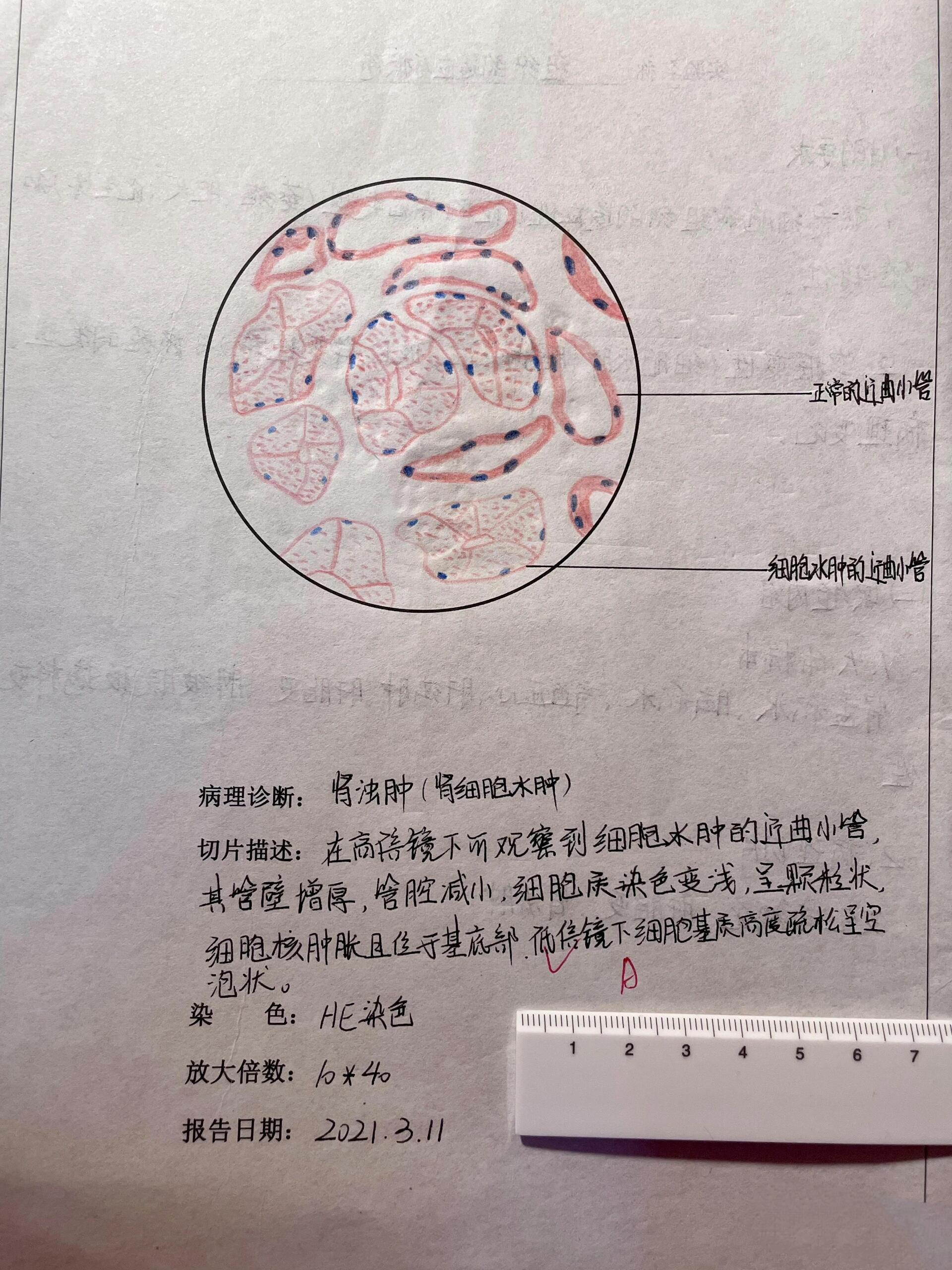 病理学肾浑浊红蓝铅笔绘图 肾细胞水肿