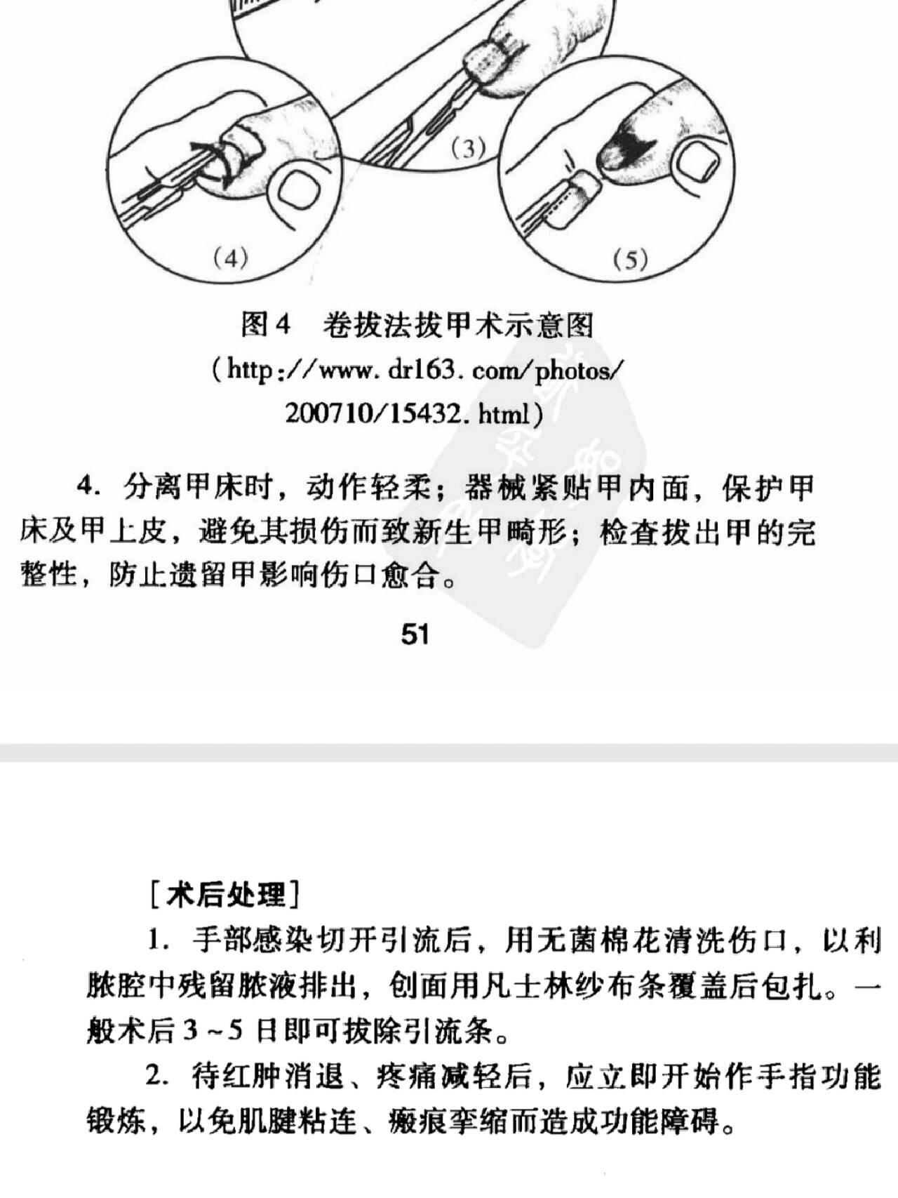 拔甲术甲沟炎 拔甲术