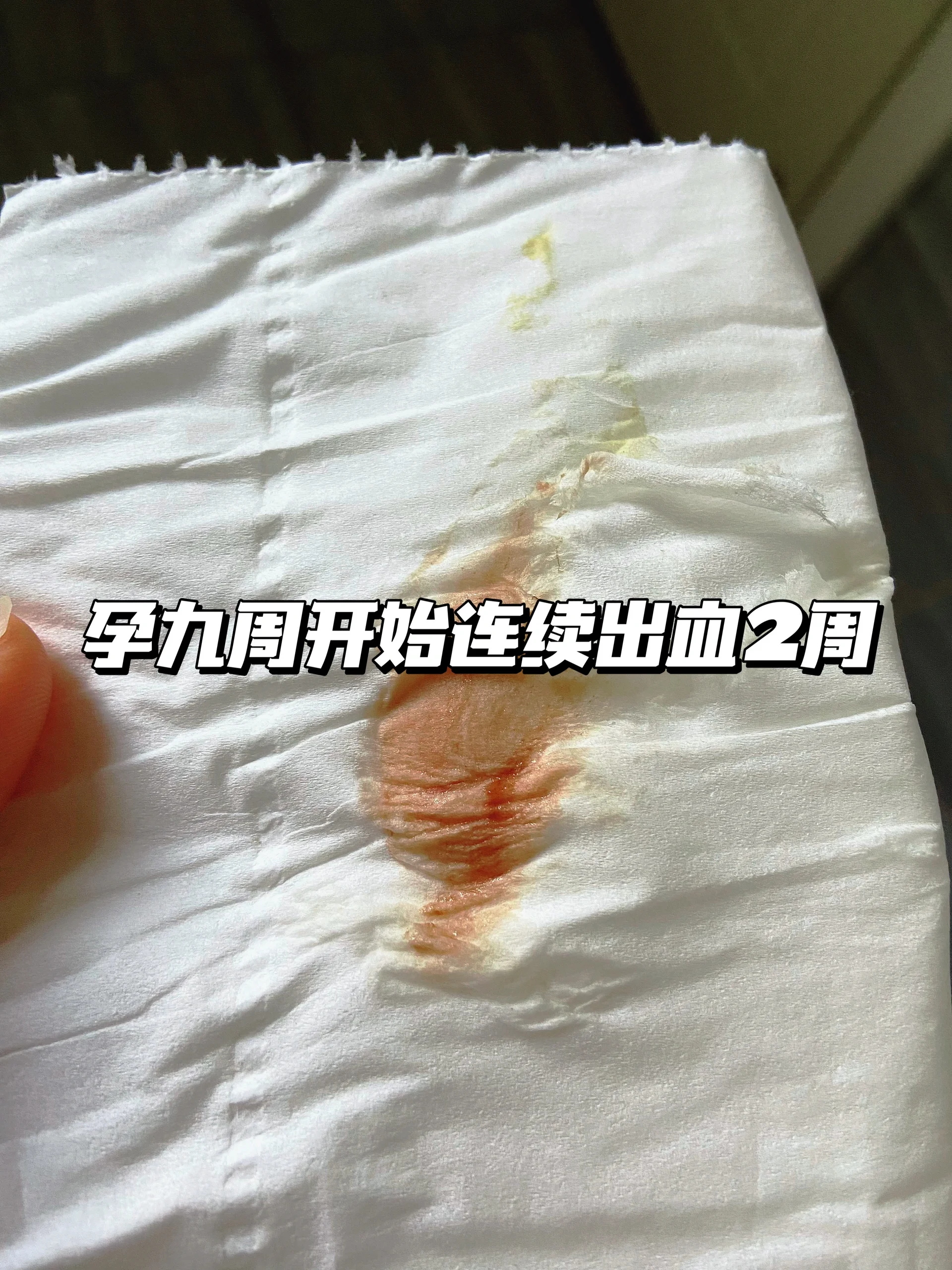 34周岁,孕期连续出血两周