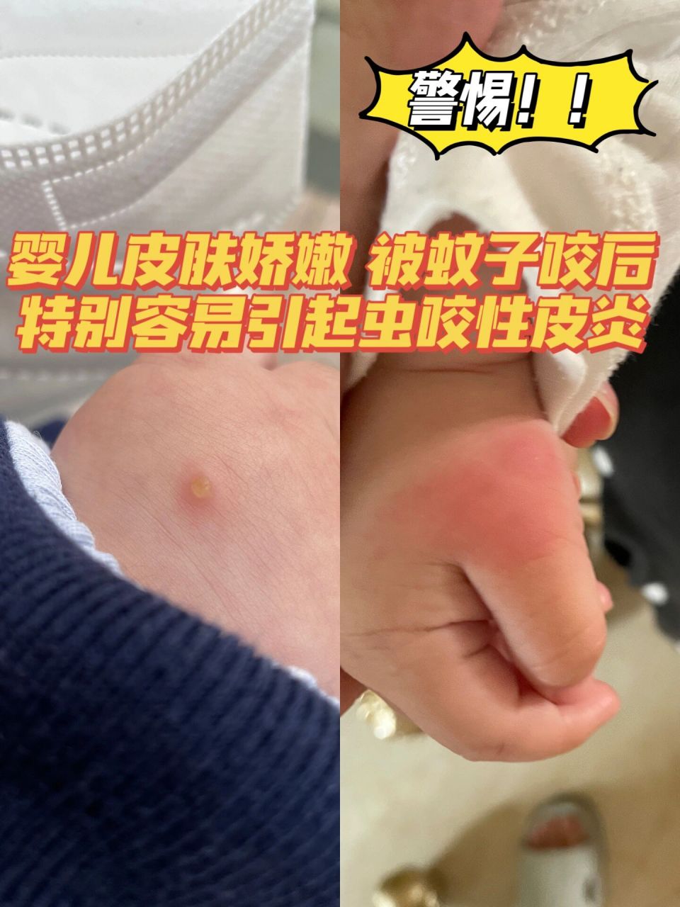 虫咬性皮炎怎么治疗图片