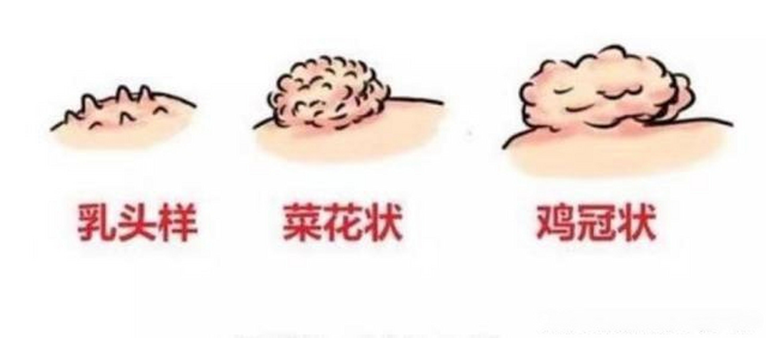 下面长了赘生物图片