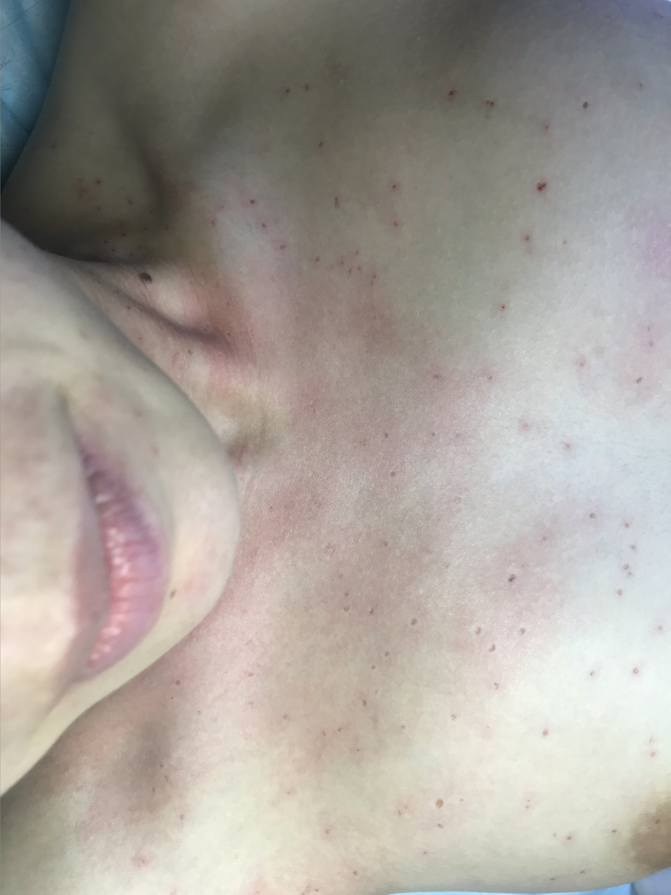 丝状疣的危害主要表现与三个方面:1,丝状疣危害女性面部,脖子等敏感