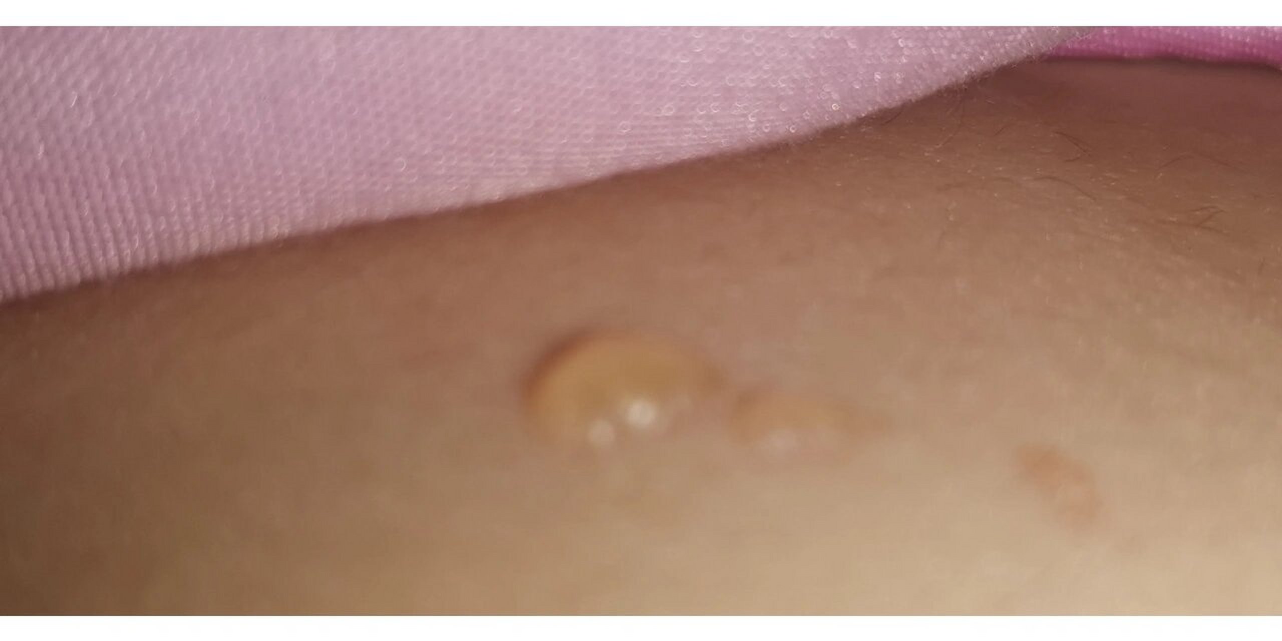 来姨妈暖贴烫起泡 就是当时觉得不怎么烫,然后直接接触皮肤贴,离那天