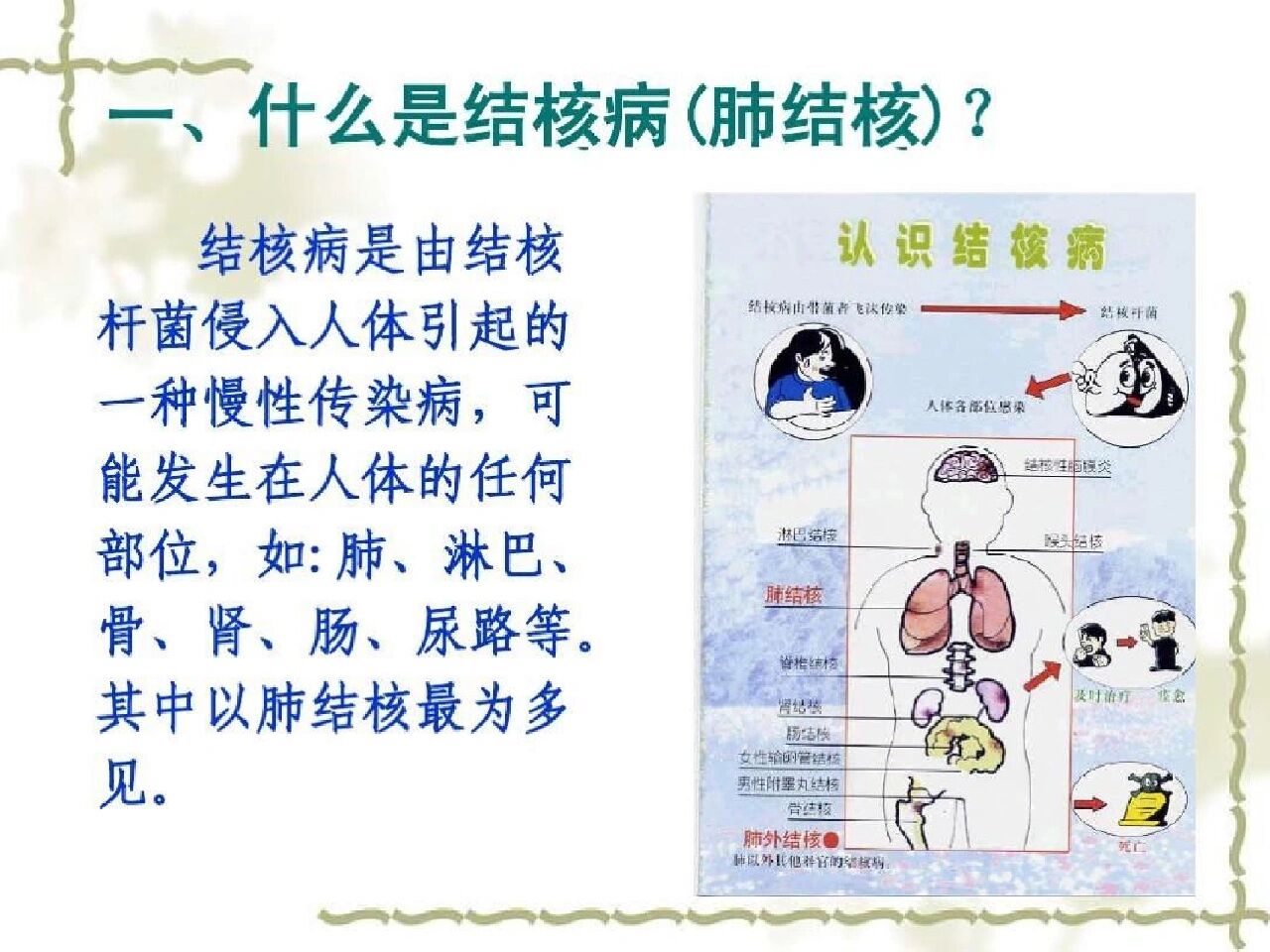 结核病是由结核分枝杆菌(简称"结核菌")感染引起的慢性传染病.