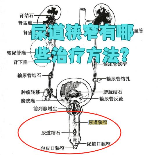 尿道狭窄的治疗方法主要有手术和非手术两种选择