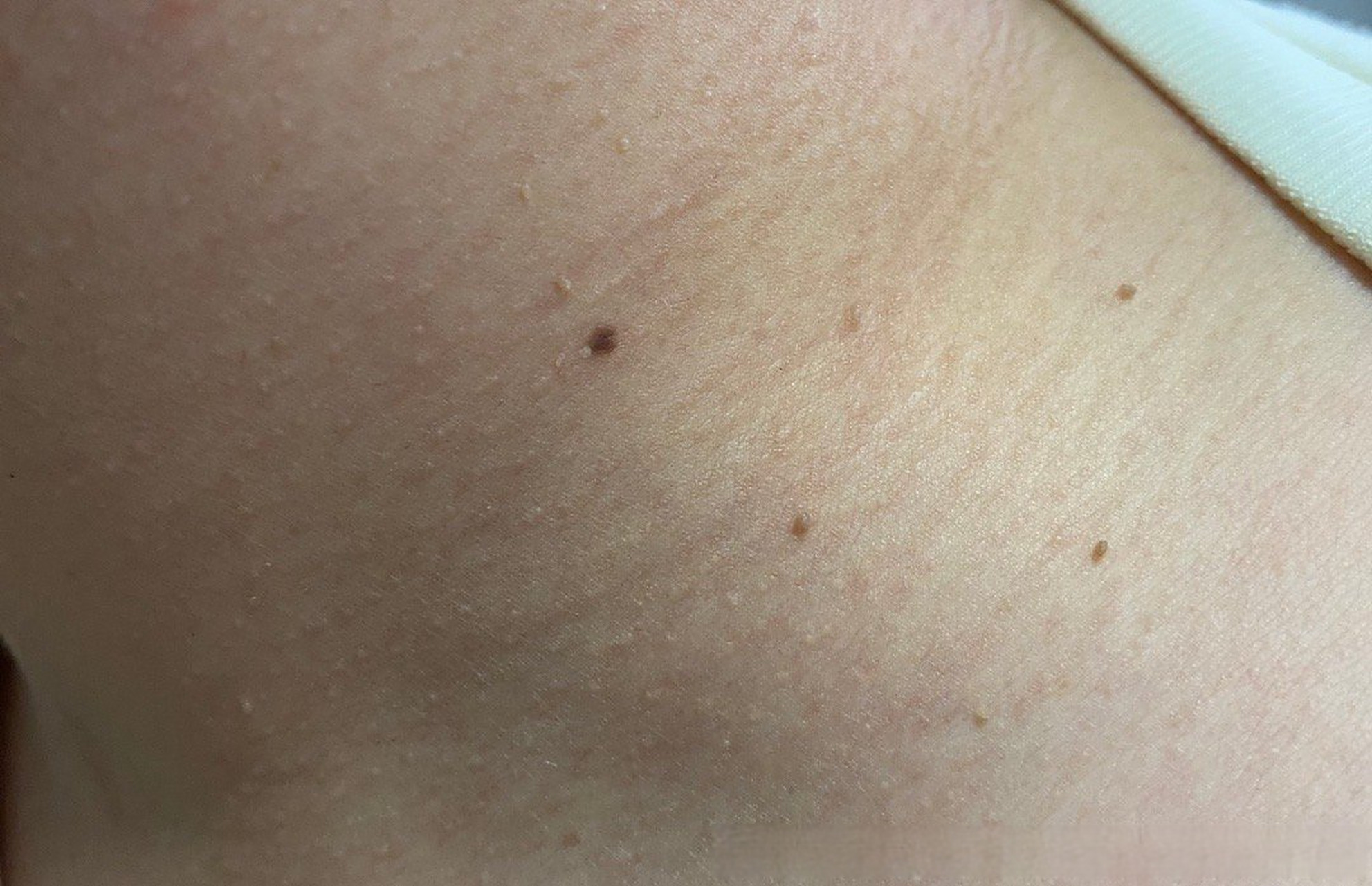 生孩子期间颈部出现小肉球,持续一年 是什么病,怎么治疗,用什么药?