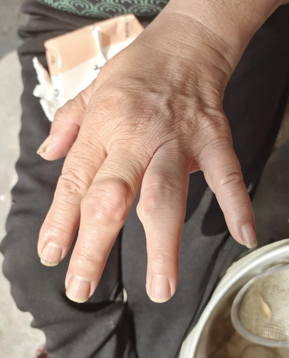 左手中指关节肿胀疼痛可能由多种原因引起,最常见的是炎症,也可能是