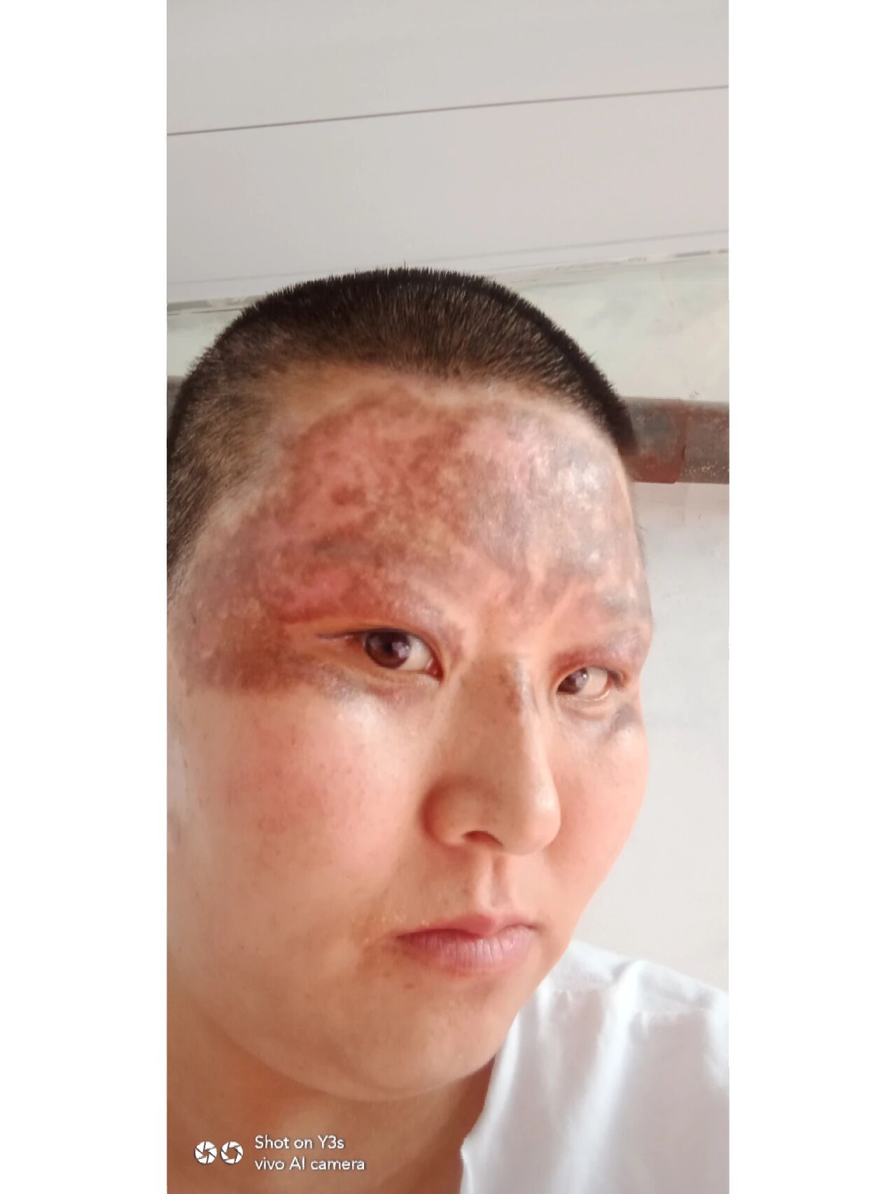 油烫伤严重到脸部面积太大,太丑了
