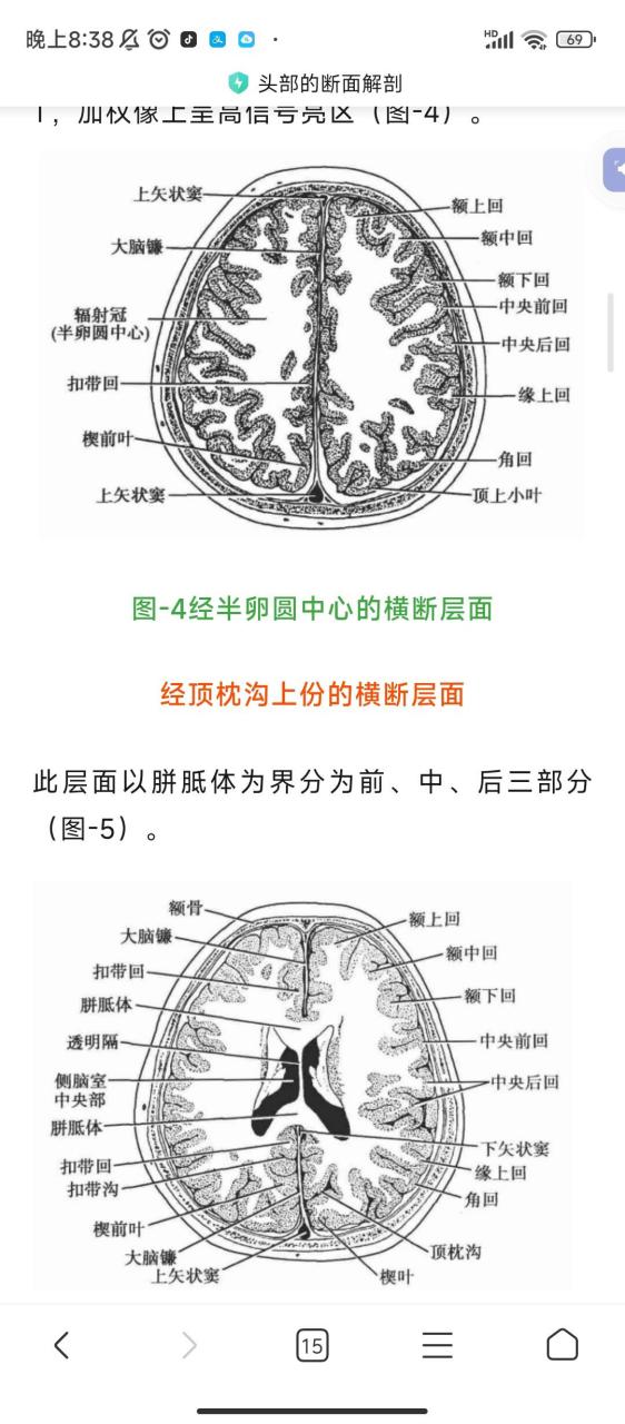经第三脑室上部横断层ct