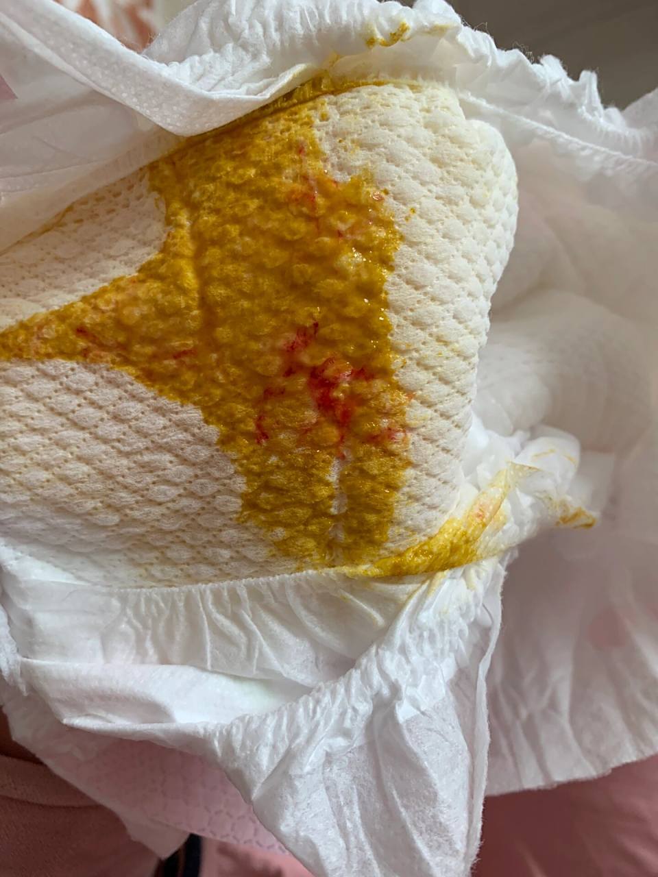 宝宝便血有啥好方法解决啊(有93图) 感觉母乳和氨基酸混合一点作用