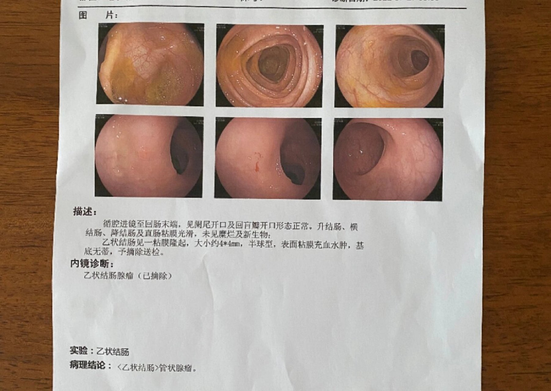 胃窦活检报告图片