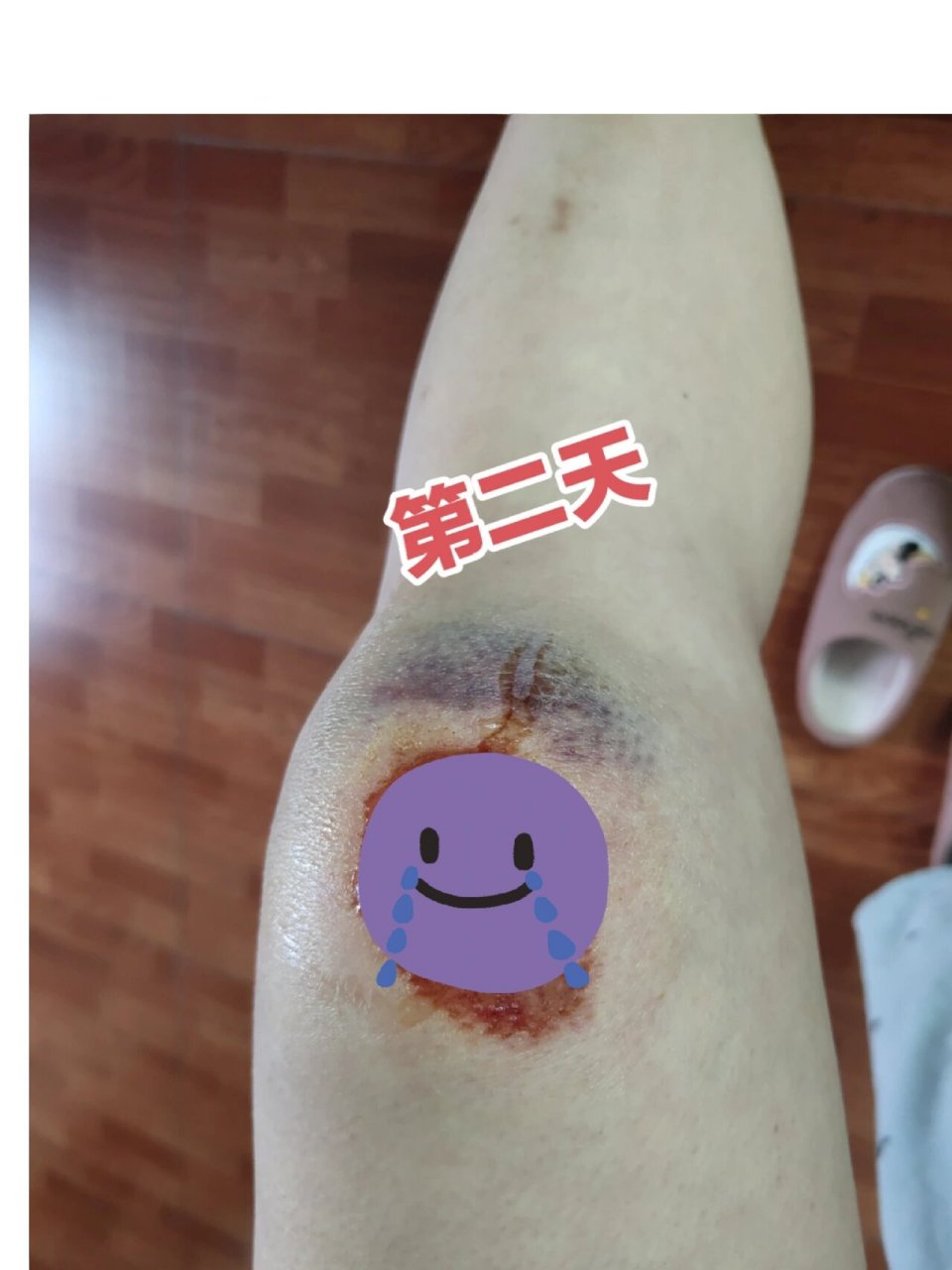 摔伤膝盖伤口结痂化脓了怎么办 第一天:骑电动车摔伤的第一天,感觉