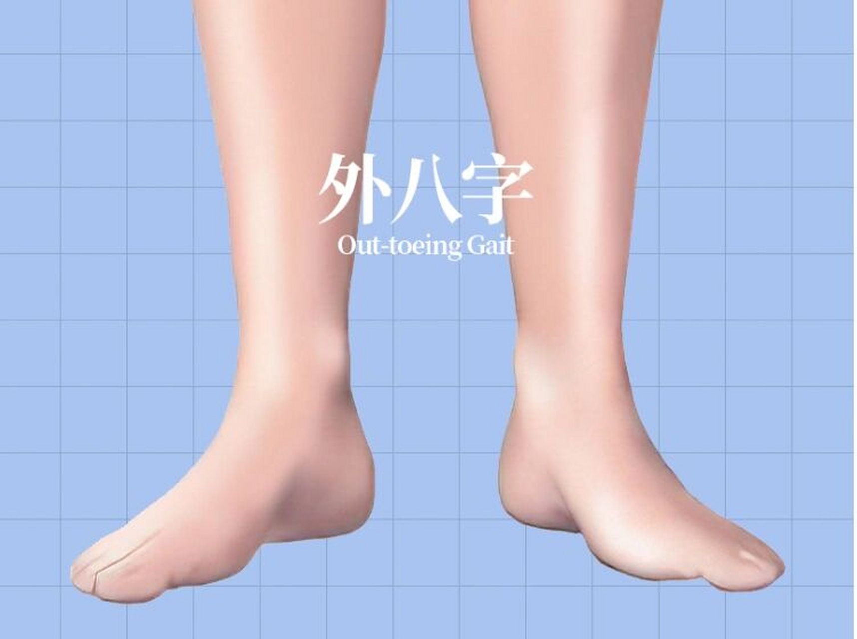 外八字走路危害多! 孩子外八走路危害多!