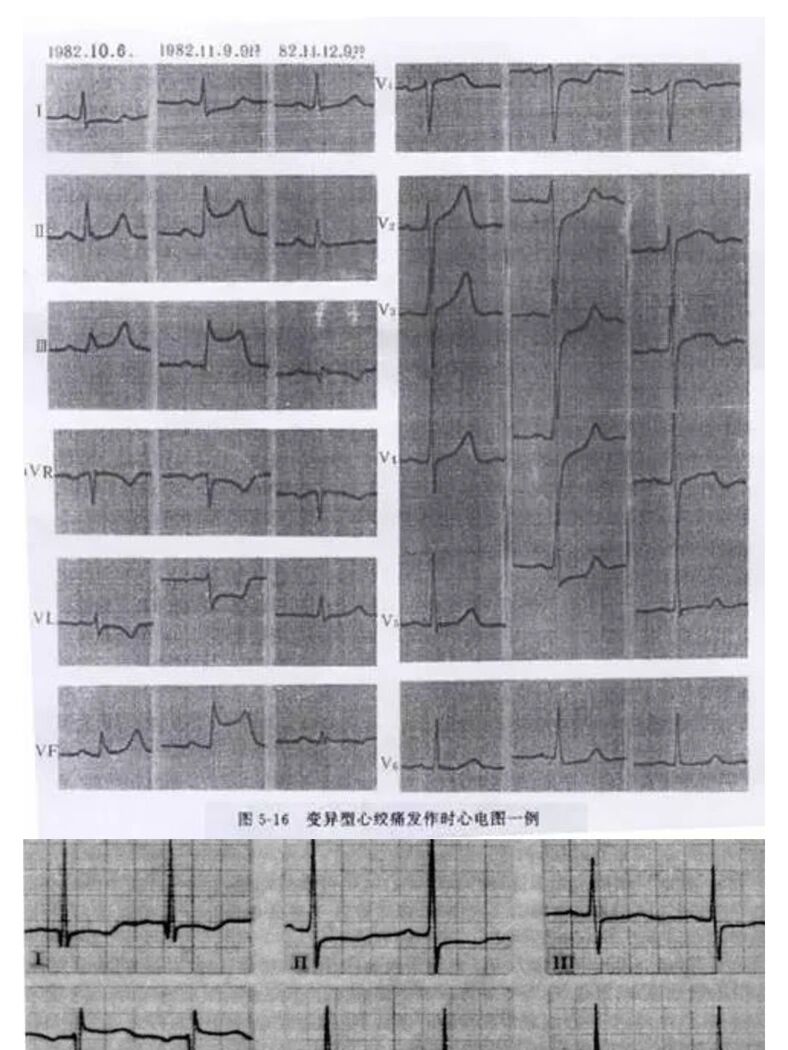 心绞痛心电图变化图片
