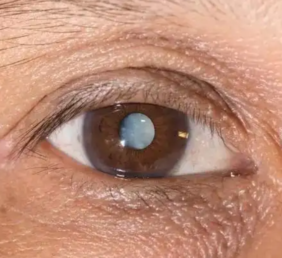 突然有一块看不清东西,可能是白内障,角膜斑翳,眼底微动脉闭塞或