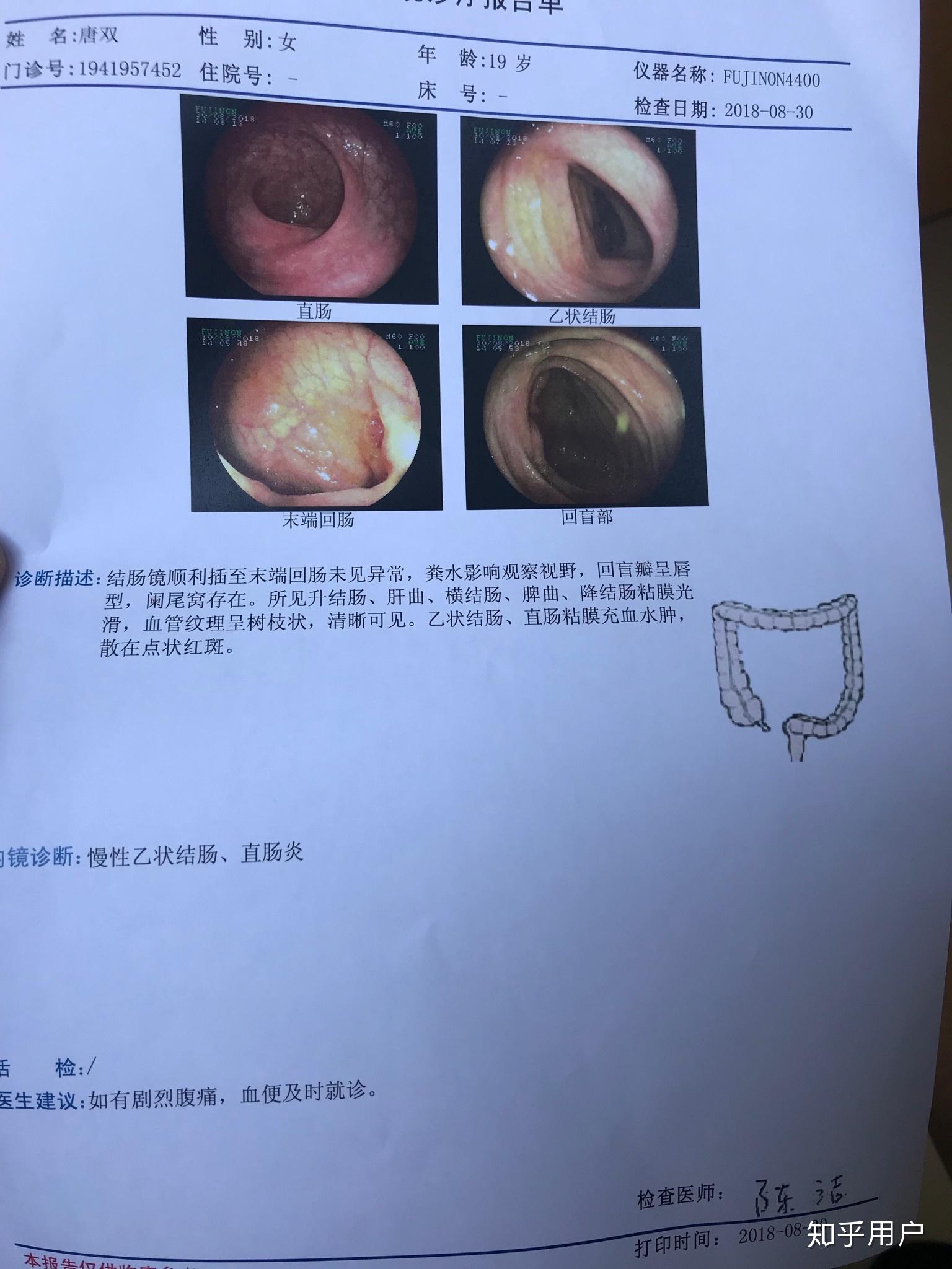 拉出一整条肠粘膜图片