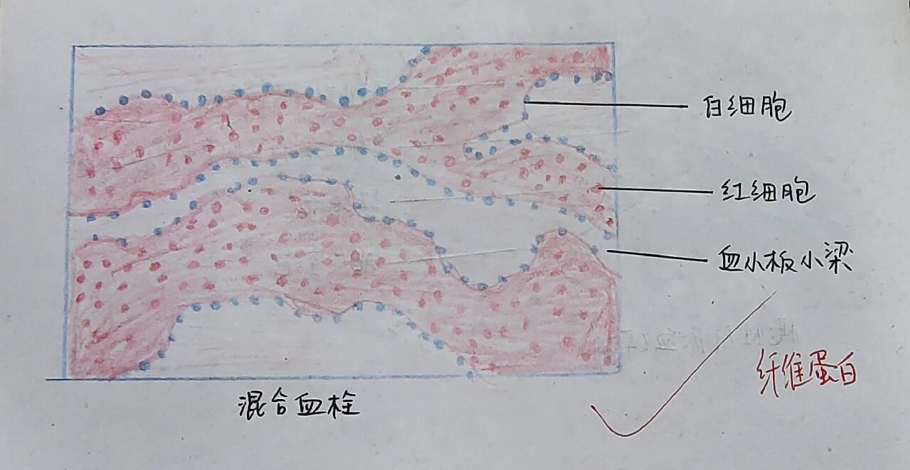 病理学实验绘图—慢性肝,肺淤血,混合血栓  慢性肝淤血——常由右心衰