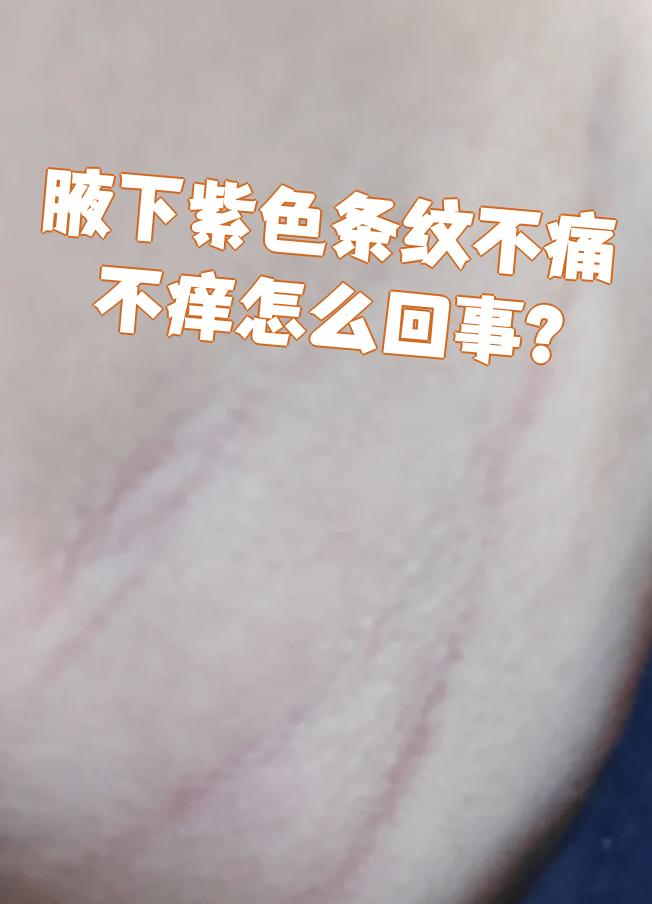是什么原因造成的腋下发紫图片腋下肥胖纹凸起库欣综合征腋下紫纹图片