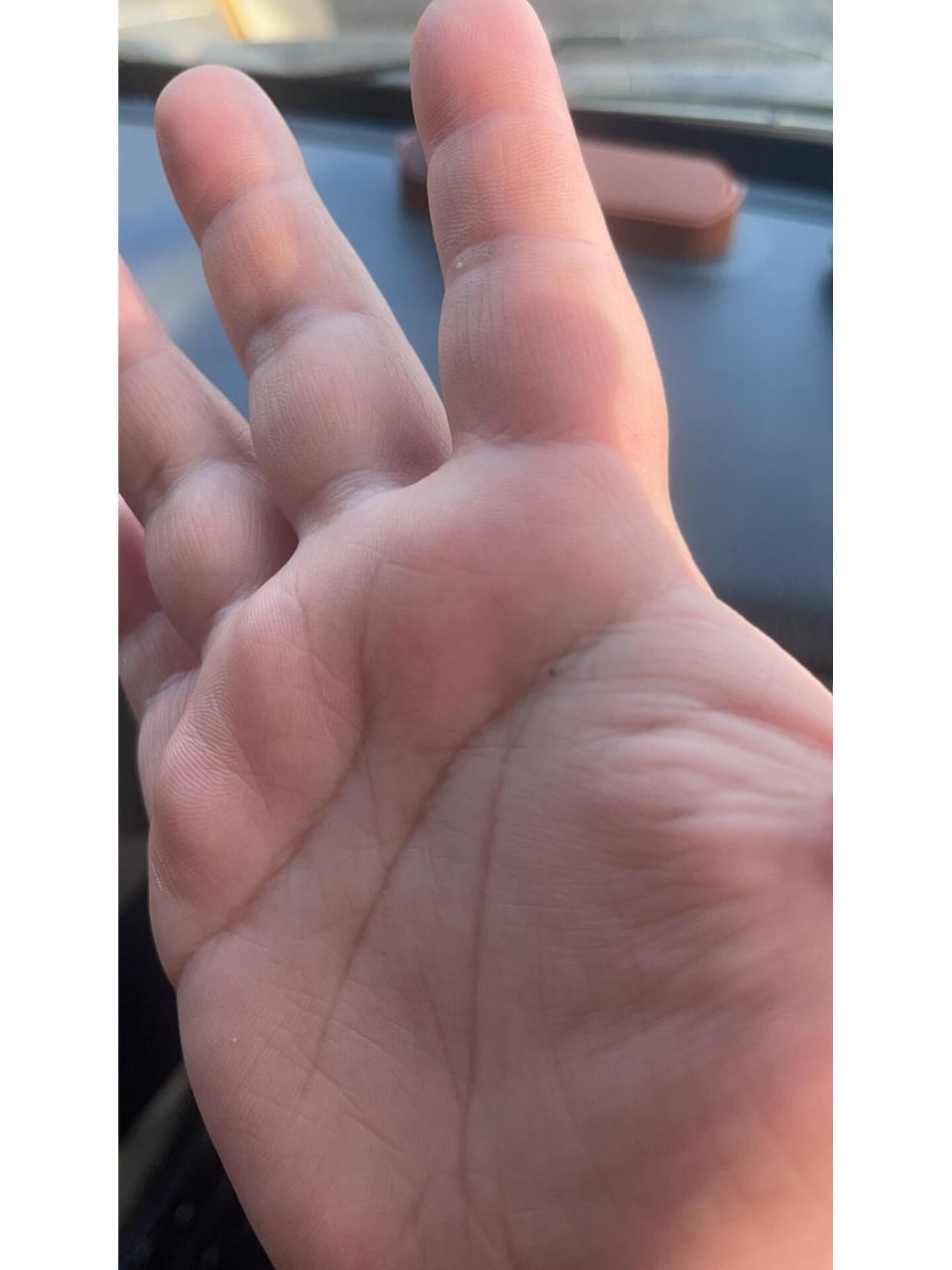 手心突然长了个痣 红色的是出血点还是朱砂痣呀有什么含义吗?