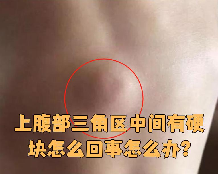 上腹部三角区中间有硬块怎么回事怎么办?