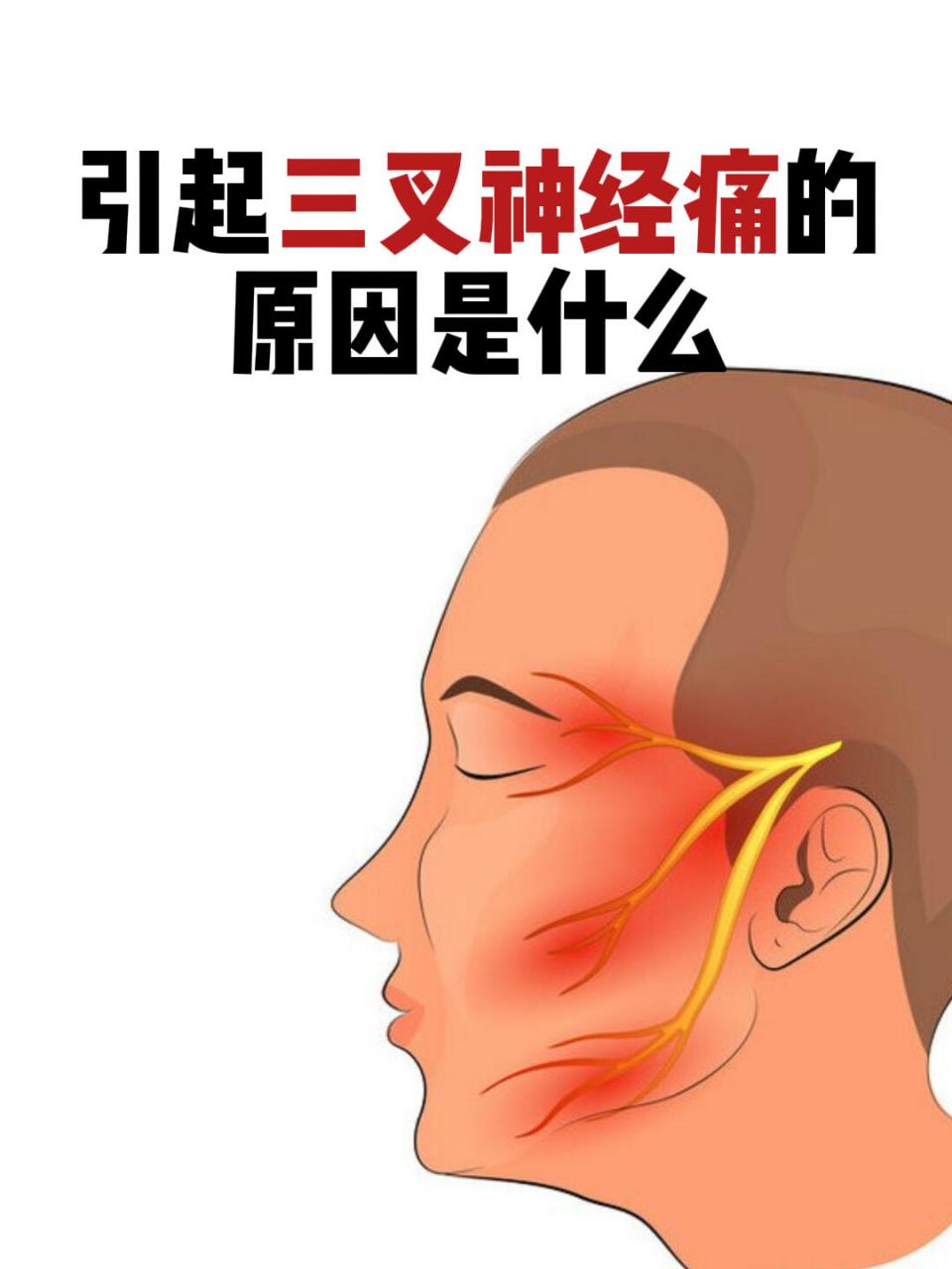 引起三叉神经痛的原因是什么 大家好,我是神经外科杨玉明医生.