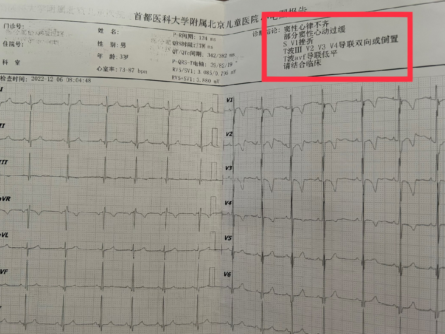 快4岁孩子的心电图,请懂的朋友看看给些建议 从孩子出生检查出卡波西