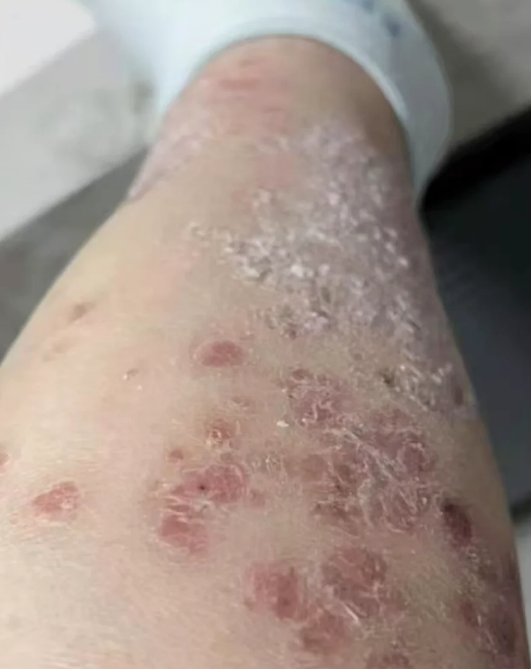 腿部出现圆形癣块,可能是体癣,银屑病或神经性皮炎引起的