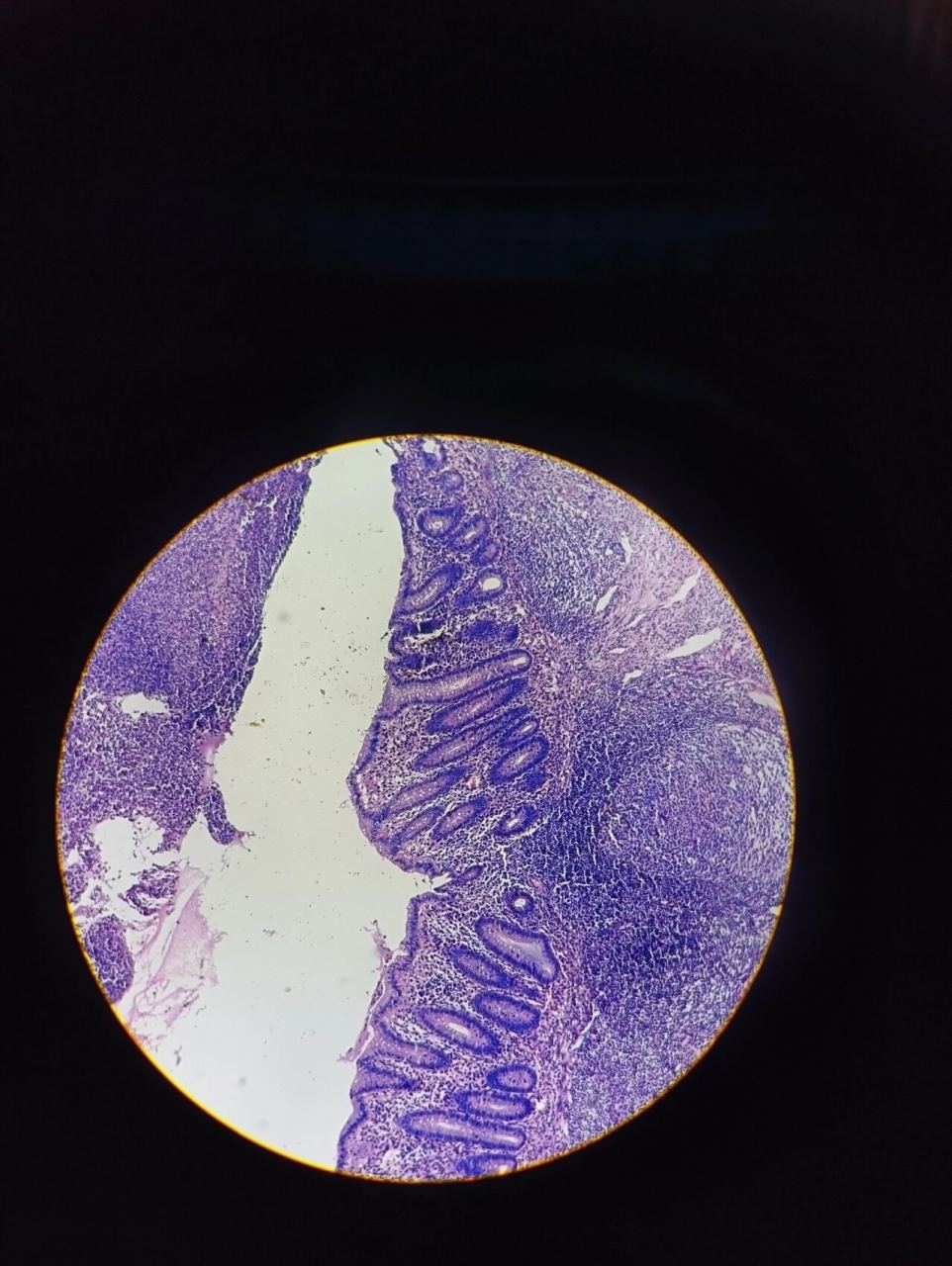 4急性蜂窝织性阑尾炎 p5肺脓肿