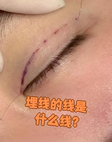 埋线双眼皮手术常用的线有两种:高分子蛋白线和尼龙线
