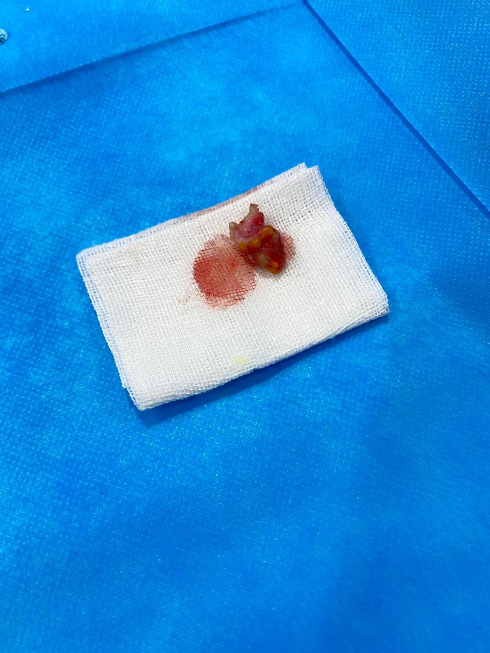 9年皮脂腺囊肿终于搞定了 13年的时候大小肩膀下面有个小豆可以挤出