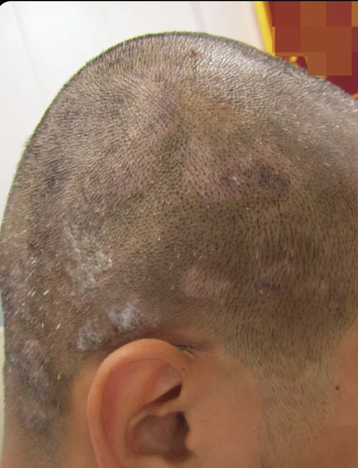 头皮起壳结痂最常见的原因是头癣和脂溢性皮炎