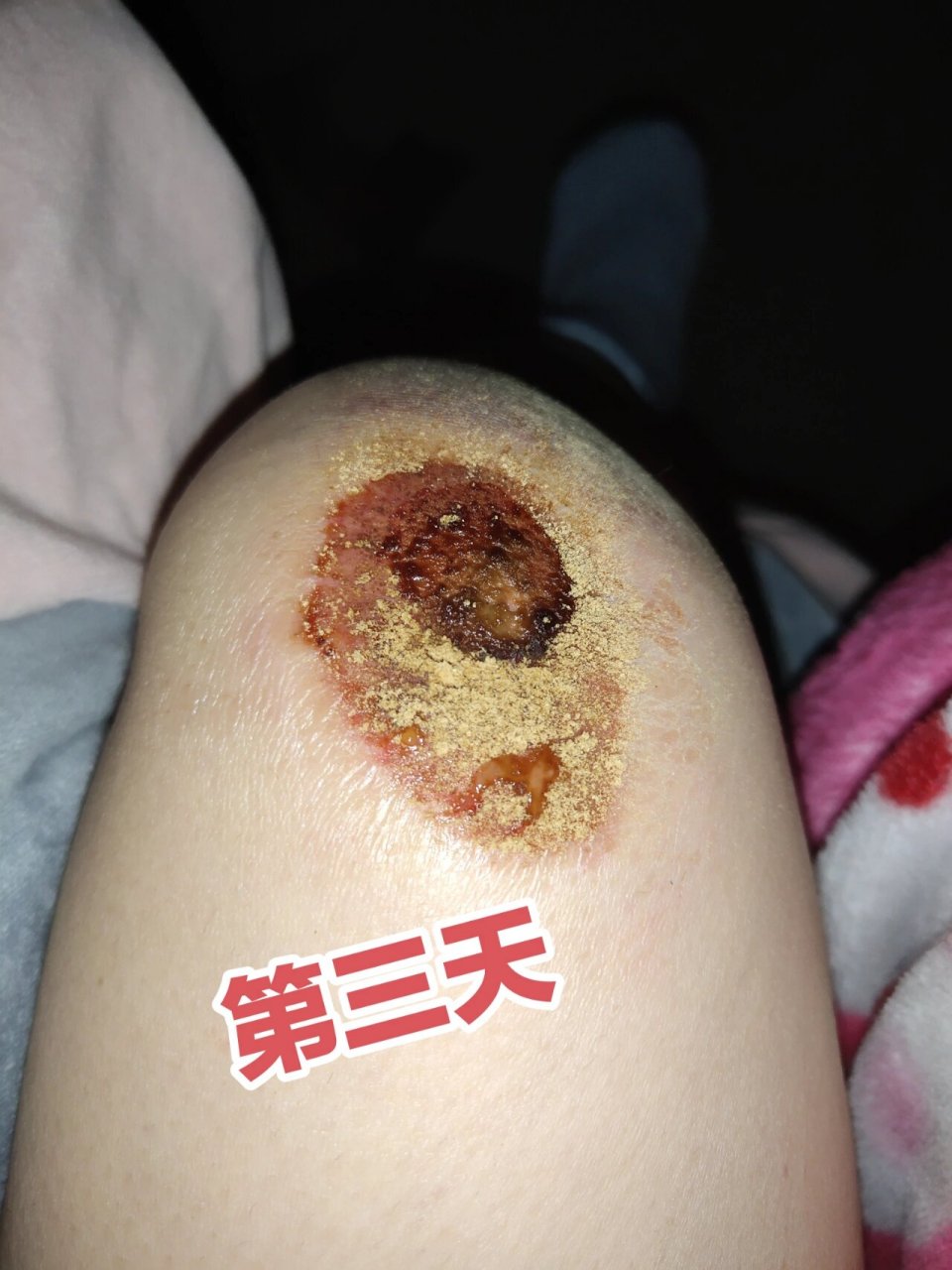 摔伤膝盖伤口结痂化脓了怎么办 第一天:骑电动车摔伤的第一天,感觉