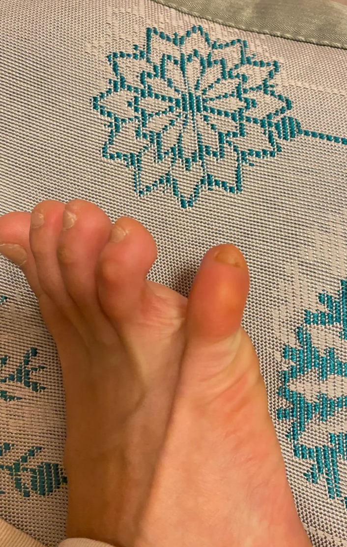 小脚趾肿胀,疼痛,变粗,红肿怎么办?