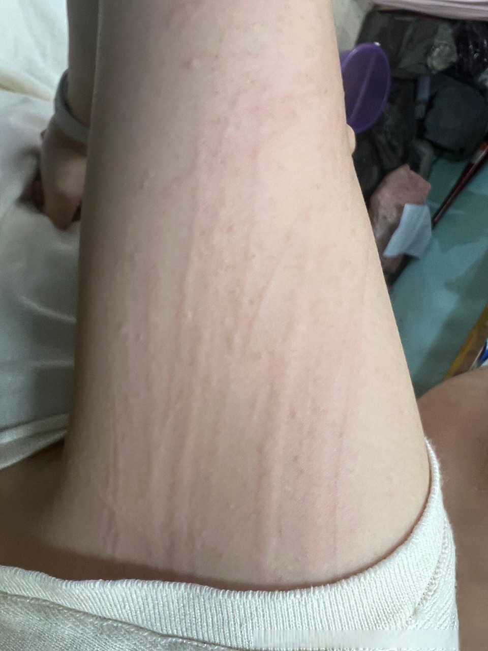 为什么洗澡后皮肤会痒