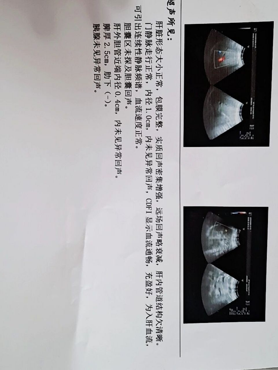 胆囊去哪了,难道看不见胆囊就是胆囊萎缩,我一点也不疼呀,就算萎缩也