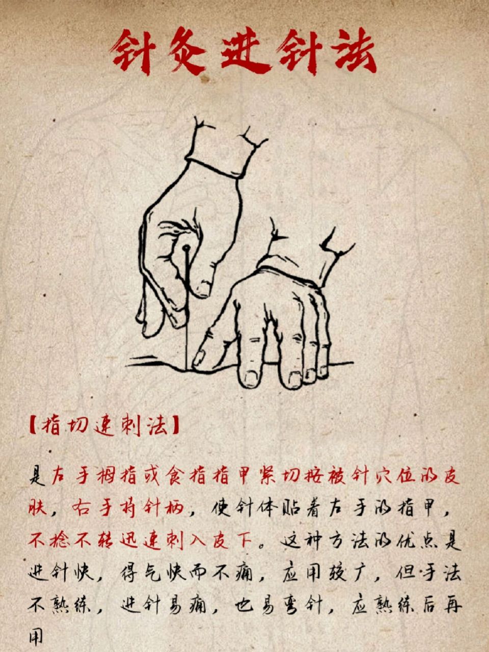 中医古法针灸进针法,针灸进针原来这么讲究 不管是在武侠小说中,还是