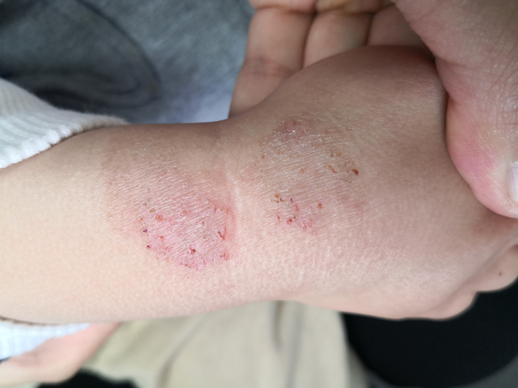 儿童腕部的湿疹症状