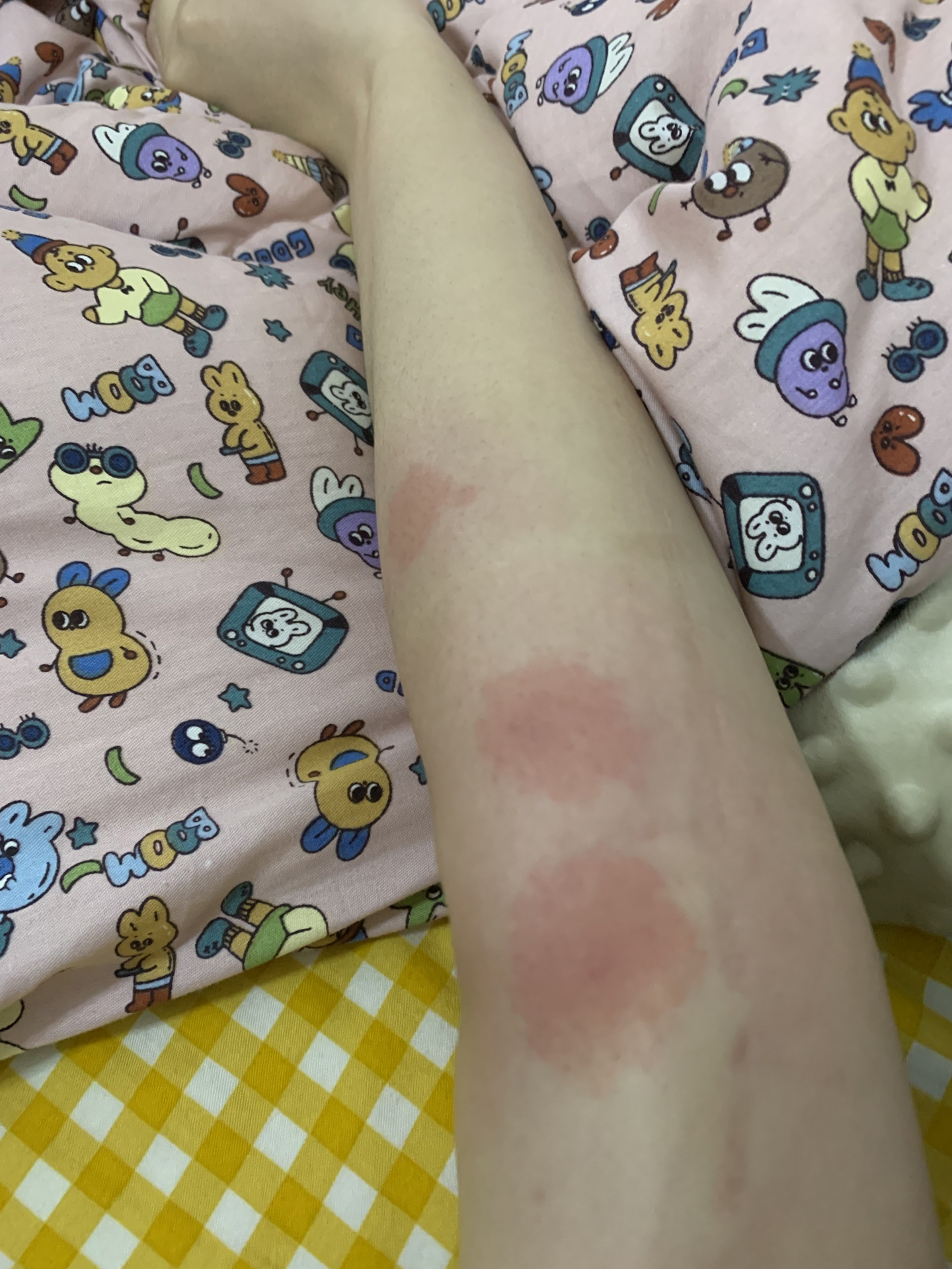 来海南过年06 刚到第二天 又被蚊虫叮咬有的朋友以为是臭蚊子03