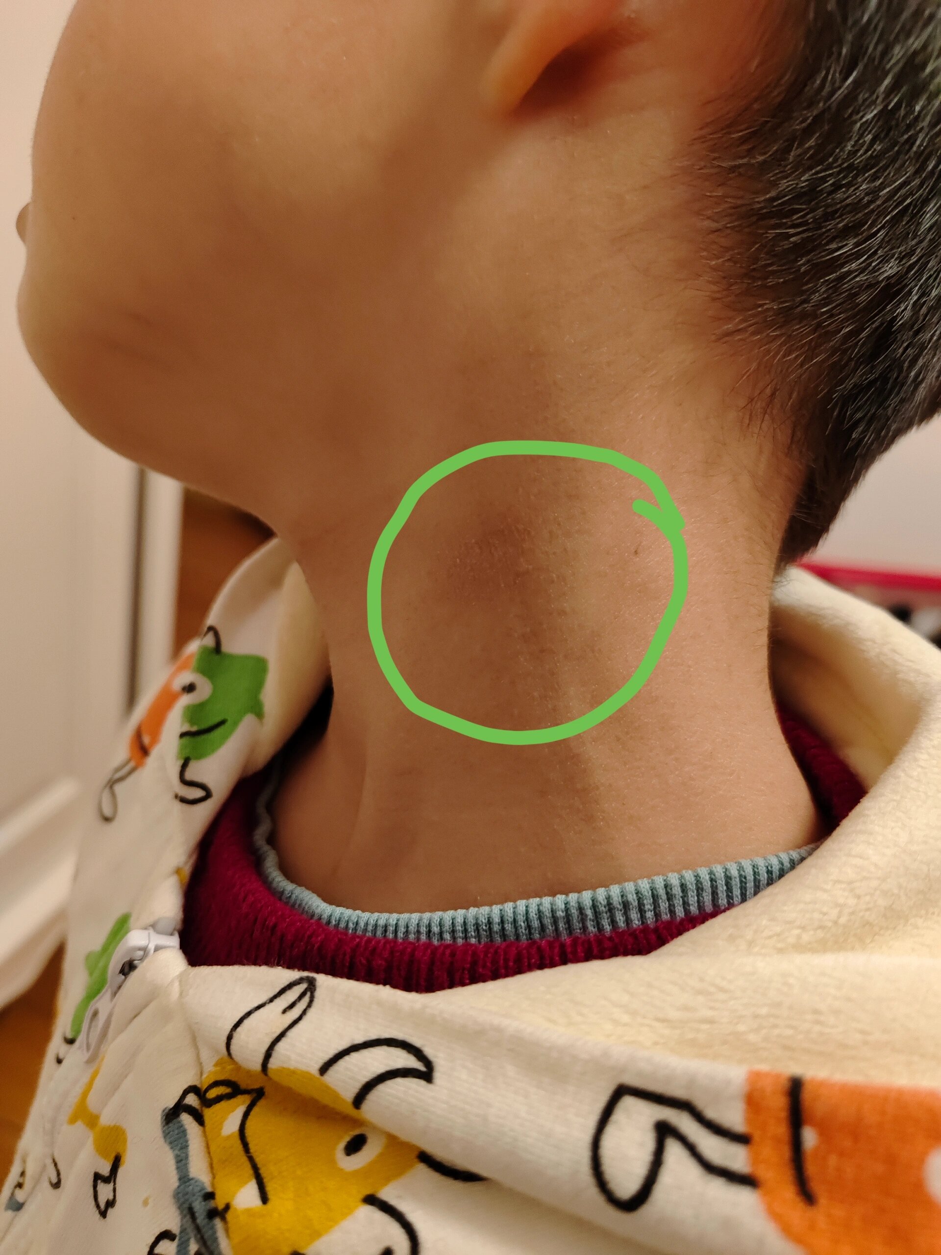 小朋友脖子上有一块像癣一样的咋回事