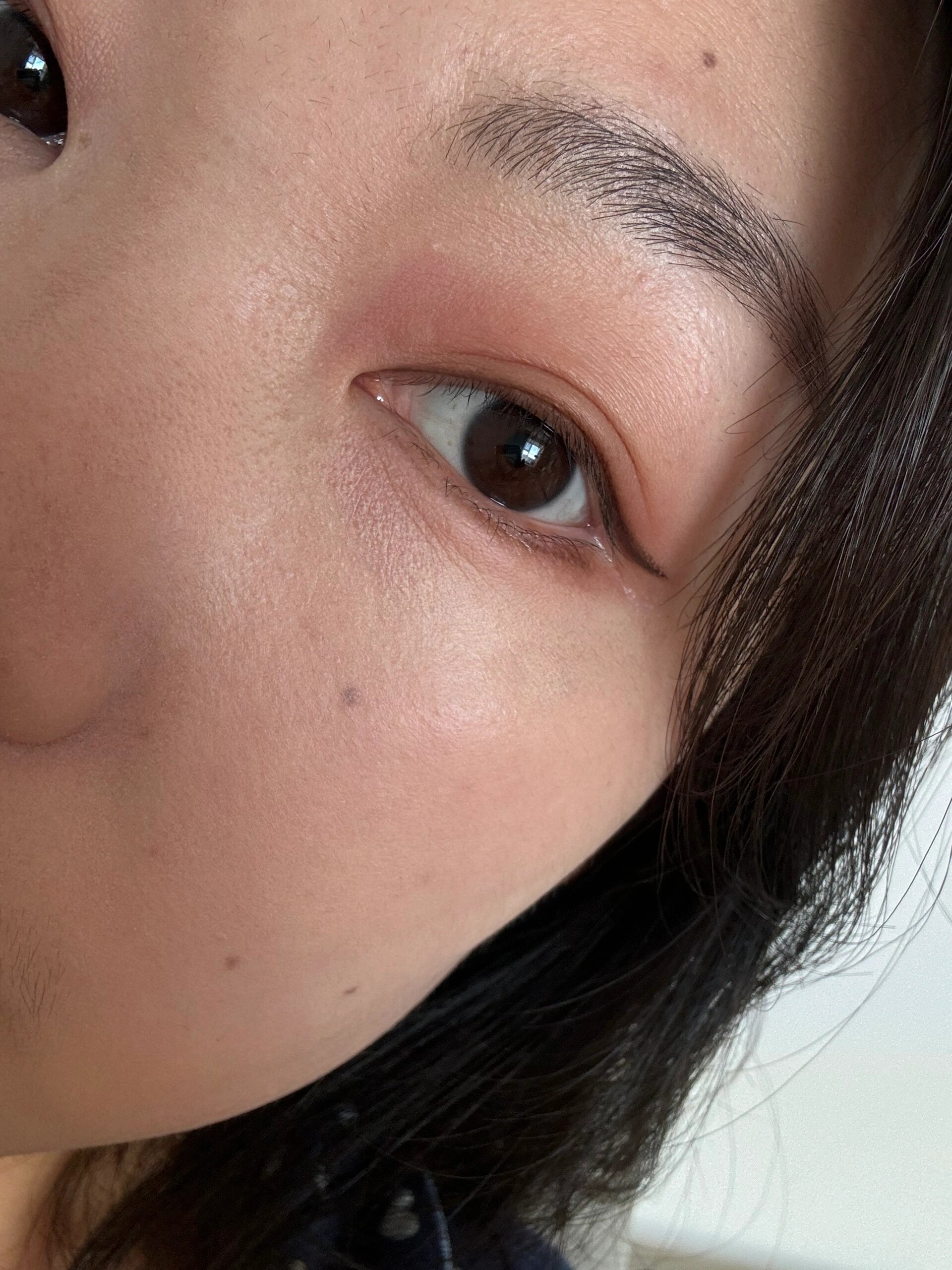 眼睛寻麻疹?眼皮上突然出现很多小包还痒